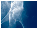 Rheumatoid Arthritis - Same Patient - Left Hip