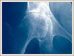 Rheumatoid Arthritis - Right Hip