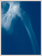 Slipped Capital Femoral Epiphysis - Lateral