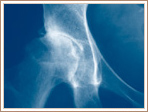 Progression of Avascular Necrosis