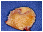 Gross Pathology