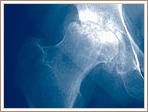 Late Avascular Necrosis