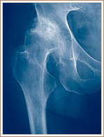 Moderate Dysplasia