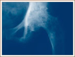 Pagets Disease