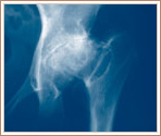 Perthes Disease
