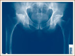 Post Traumatic Osteoarthritis