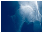 Primary Osteoarthritis - Advanced