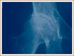 Primary Osteoarthritis - Early