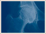 Primary Osteoarthritis - Protrusion
