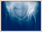 Severe Hip Dysplasia