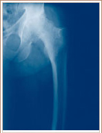 Slipped Capital Femoral Epiphysis - Anteroposterior